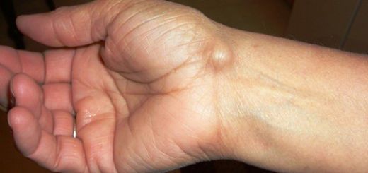 Bileğin İç Kısmında Şişlik Belirtileri ve Tedavisi