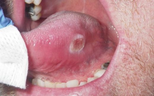 Dil Altında Şişlik Belirtileri ve Tedavisi