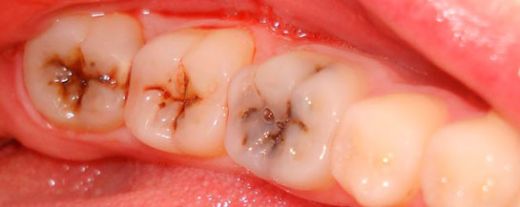 Diş Apsesi Şişliği Nasıl İner?