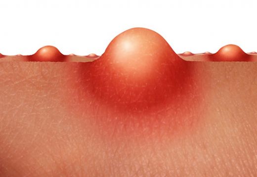 Genital Bölgede Şişlik Belirtileri ve Tedavisi