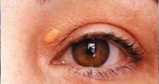 Göz Kapağında Küçük Şişlik Belirtileri ve Tedavisi