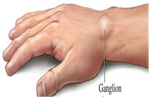 Kemikte Şişlik Belirtileri ve Tedavisi