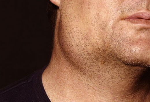 Kulak Altında Şişlik Belirtileri ve Tedavisi