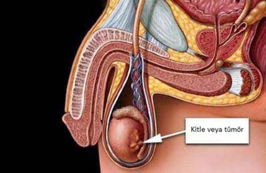 Testiste Şişlik Belirtileri ve Tedavisi